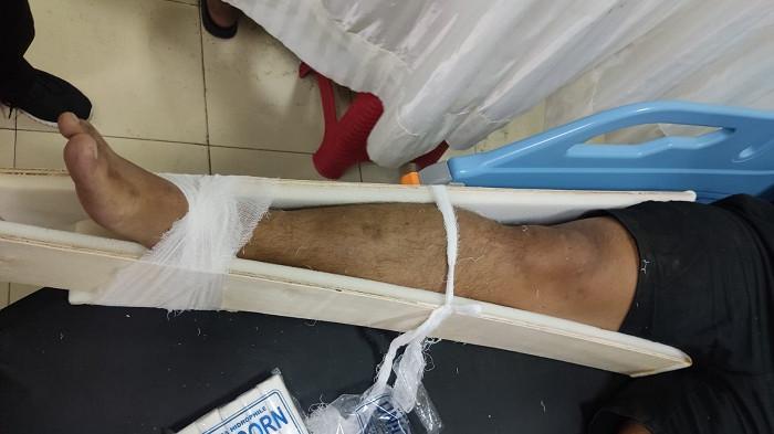 PENGEROYOKAN - IGW (31) korban pengeroyokan geng anak muda saat mendapat perawatan di RSUD Wangaya. Ia mengalami patah tulang kaki.