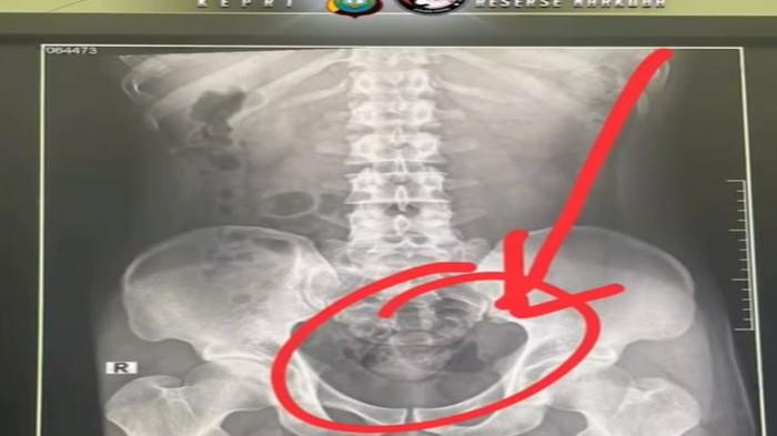 Hasil rontgen kurir narkoba di Batam