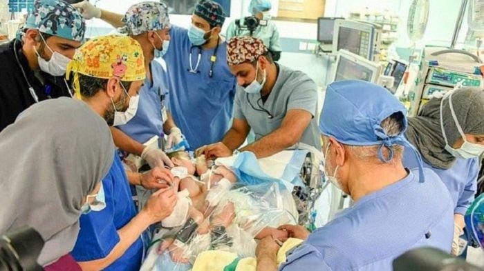 Bayi Kembar Siam Asal Irak Jalani Operasi Pemisahan di Rumah Sakit Arab Saudi, Butuh Waktu 11 Jam