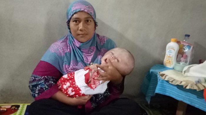 Juni Ulfa, Bayi Penderita Hidrosefalus dari Samadua Butuh Bantuan Biaya Pengobatan