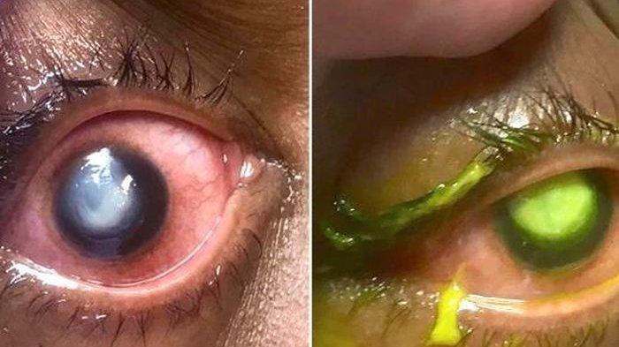 Bahaya Tidur Masih Memakai Lensa Kontak, Dari Infeksi Kornea hingga Kehilangan Penglihatan