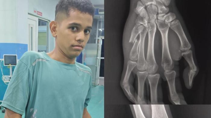 PATAH TULANG JARI - M Mouli Riski (18), mengalami patah tulang jari tangan kanan saat berlaga di babak delapan besar Prapora di Kabupaten Pidie, Sabtu (16/5/2026). 