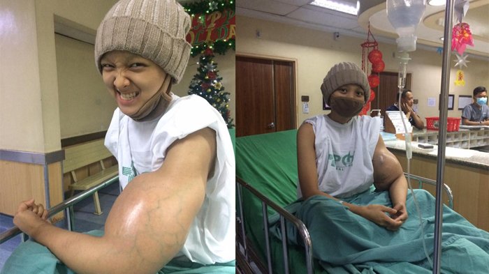 Dikira Gigitan Nyamuk, Benjol di Tangan Gadis Ini Ternyata Penyakit Mengerikan, Hingga Diamputasi