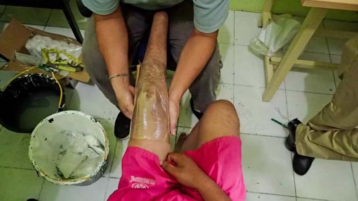 Penyandang Disabilitas  Dapat Kaki dan Tangan Palsu