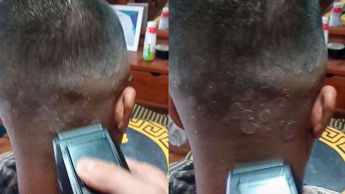 Viral Kepala Pria Ini Dipenuhi Psioriasis Bikin Merinding, Kenali Penyebab dan Cara Mengatasinya