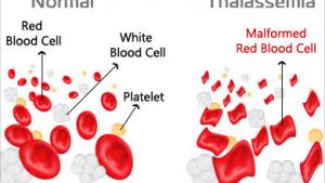thalassemia_20151107_101426.jpg
