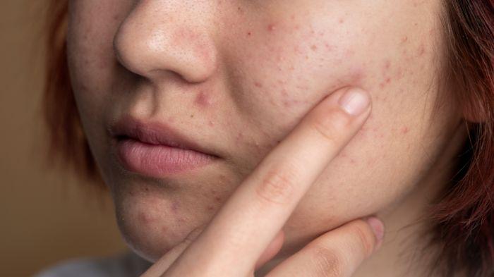 Ternyata Fungal Acne Berbeda Dari Jerawat, Kenalin Gejalanya dan Pencegahannya