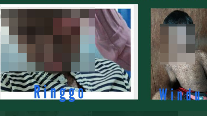 Dua Bocah Diserang Tumor Ganas, Awalnya Cuma Bintik Hitam, Kini Matanya tak Bisa Melihat Lagi