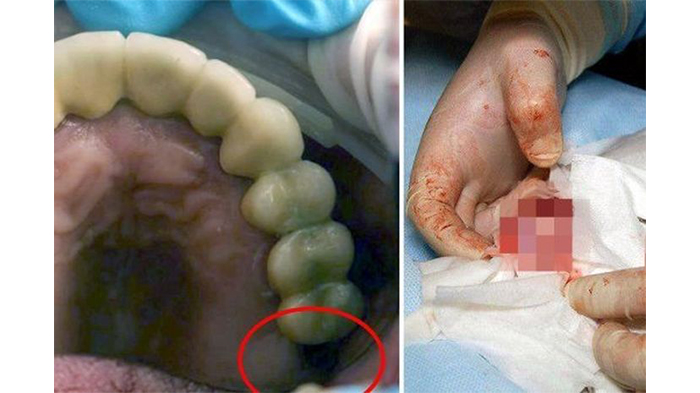 Tidak Tumbuh di Rahang, Gigi Geraham Bocah 13 Tahun Ini Justru Muncul Dalam Alat Vitalnya