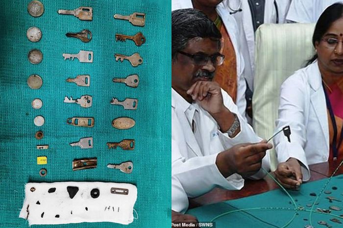 Kasus Langka, Dokter Temukan 38 Benda Logam dan Kartu Sim dalam Tubuh Pasien