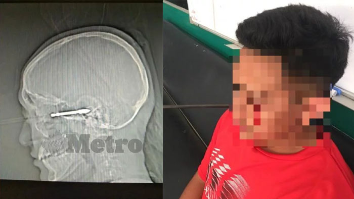 Seorang Remaja Tertembak Anak Panah saat Latihan di Sekolah, Kena di Mata hingga Tembus ke Telinga