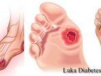 ilustrasi-luka-diabetes.jpg