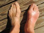 ilustrasii-kaki-asam-urat.jpg