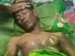 Kondisi Warga Reje Pudung yang Tersengat Arus Listrik Kini Mulai Membaik