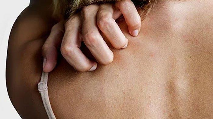 Simak 5 Bahan Alami untuk Menghilangkan Panu, Mulai dari Cuka Apel hingga Bawang Putih