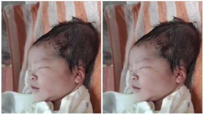 VIRAL Bayi Berkepala Lonjong karena Ditarik Vacum, Dokter Kandungan: Bisa Normal dalam 2 Minggu