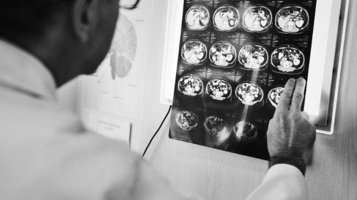 AVM-penyebab-stroke.jpg