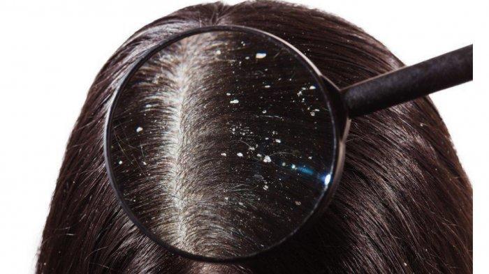 ketombe-adalah-kondisi-yang-dapat-menyebabkan-kulit-kepala-gatal.jpg