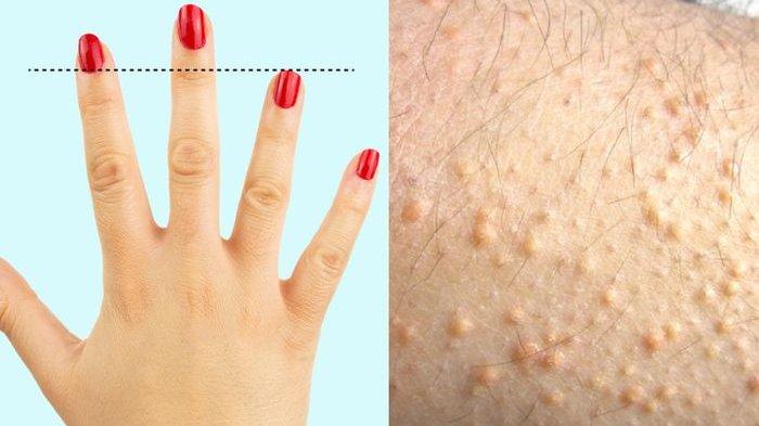 7 Tanda Penyakit Jantung Bisa Dilihat Dengan Mata Telanjang, Termasuk Bintik Ini