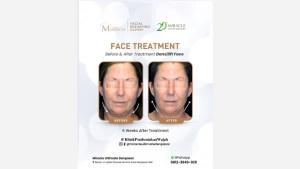 Ultimate-miracle-face-treatment-before-after.jpg
