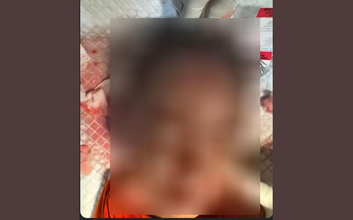 Balita-berusia-3-tahun-asal-Desa-Culik-Karangasem-I-Gede-WP-diterkam-anjing.jpg
