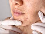 hilangkan-segera-flek-hitam-di-wajah-dengan-cara-sederhana-dan-murah-dijamin-aman.jpg