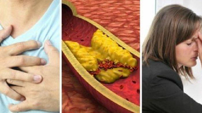 Banyak Makan Daging Saat Lebaran, Begini Teknik Cara Menurunkan Kolesterol Tinggi dan Darah Tinggi