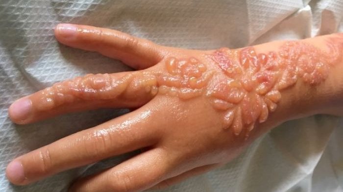 Bikin Tato Henna, Gadis Ini Akhirnya Menderita, Jangan Sampai Putri Anda Seperti Ini Ya!