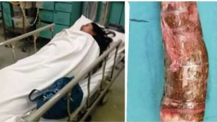 Nekad Masukkan Singkong Berbalut Kondom ke Organ Intim, Nasib Wanita Ini Sungguh Memilukan