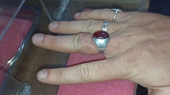 Kondisi Terakhir Pria Asing di Palangkaraya yang Kesulitan Melepas Cincin Terpasang di Jarinya