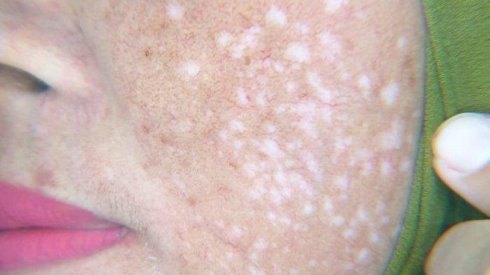 Cerita Warga Banjarmasin Pengguna Kosmetik Ilegal, Wajah Sempat Glowing hingga Kemudian Terkelupas