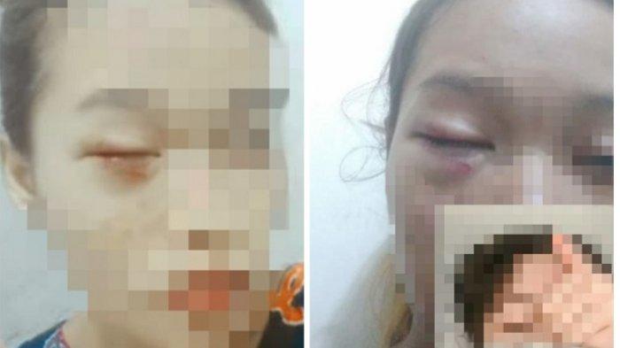Trauma dan Lebam di Mata, Korban Penganiayaan 3 Cewek Banjarmasin Baru Kenal Pelaku