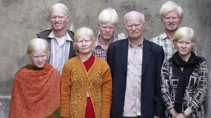 Dari Ayah Sampai Cucu Punya Kelainan yang Sama! Inilah Keluarga Albino Terbesar di Dunia