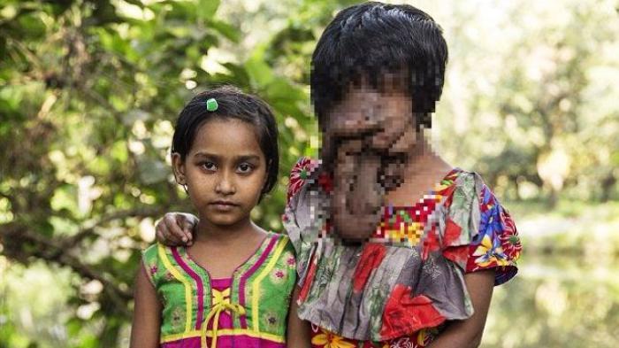 Help Khadija. Beratnya Cobaan Gadis India Berwajah Mirip Belalai - khadija_20151107_114835.jpg