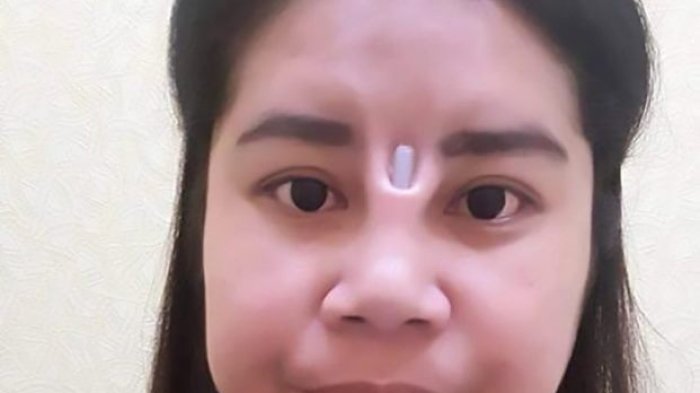 Hiii, Bukannya Cantik, Usai Operasi Hidung Malah Mengerikan! Simak Kisahnya