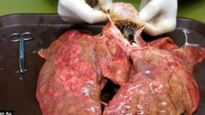 Beginilah Bentuk Paru-paru Perokok