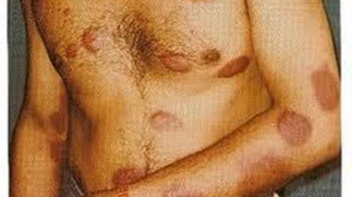 Puskesmas Lokpaikat Deteksi Penyakit Kusta