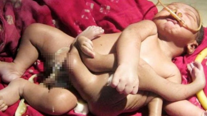 Heboh, Bayi Lahir dengan Empat Kaki dan Tangan di India Dianggap Titisan Dewa