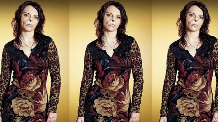 Kasihan, Wanita Ini Kehilangan Separuh Wajahnya Akibat Virus Meningitis