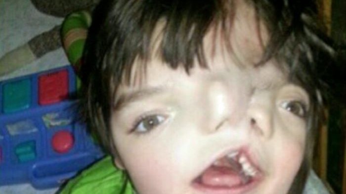 Bocah Dua Wajah Ini Divonis Berusia Pendek, Siapa Sangka Bertahan Selama 13 Tahun