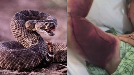Selfie Sama Ular Berbisa Malah Digigit dan Harus Bayar Rp 2 Miliar