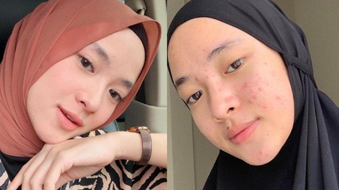 nissa-cantik-jerawat.jpg