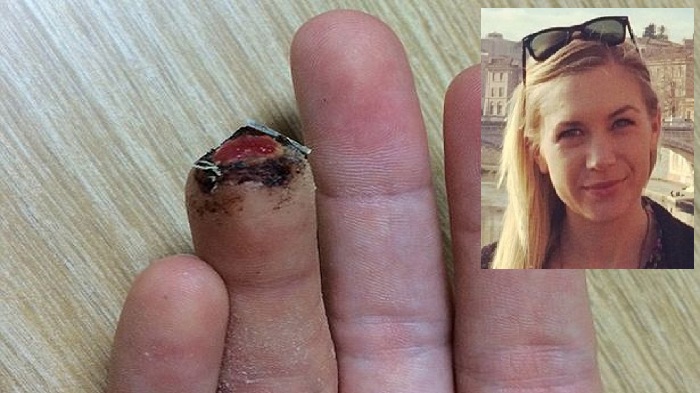 Jemari Perempuan Ini Putus karena Digigit Kuda Polisi