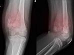 Foto-Ilustrasi-gambar-sinar-X-osteosarkoma-di-lutut.jpg