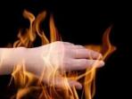 ilustrasi-luka-bakar.jpg