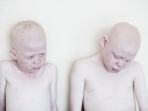 kondisi-anak-kelainan-genetik-atau-albino-di-tanzania_20170322_105501.jpg
