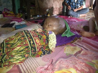 Raudatul Berharap Bantuan untuk Ilma yang Menderita Hydrochepalus