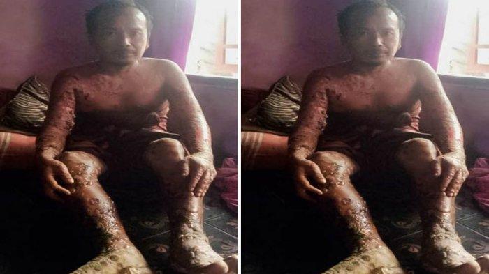 Sobari Menderita Penyakit Kulit di Sekujur Tubuhnya Seperti Terbakar, Ia Tak Mampu Berobat