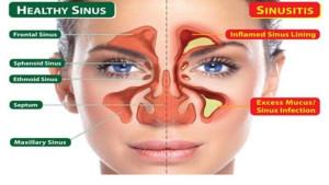 Ilustrasi-sinus-dan-sinusitis.jpg