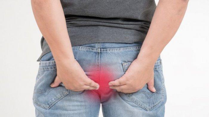BISA DICOBA! Begini Cara Sederhana Atasi Wasir Agar Tak Kambuh